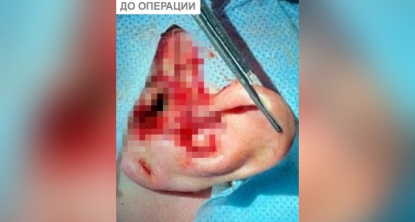 Кировские врачи помогли молодому велосипедисту с оторванным ухом