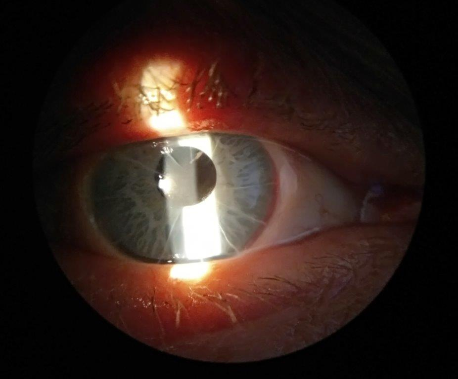 Кировские врачи провели первую операцию по имплантации радужки глаза