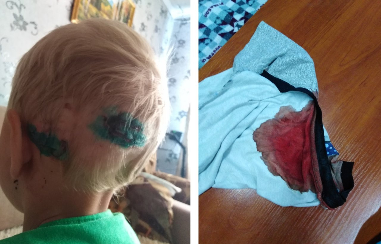 «Увидел окровавленного сына и побежал за битой: в Демьяново собака напала на 5-летнего ребенка